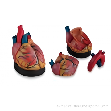 Enlarged Heart Anatomy Model